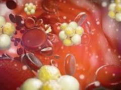 High cholesterol. Hand sensations that indicate a problem