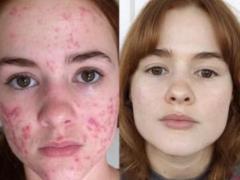 Кухонные ингредиенты против зимних прыщей
