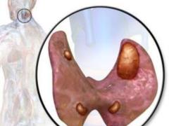 Treatment of partial parathyroid insufficiency. Part 3