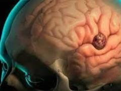 The Independent: an oncologist named the main symptoms of a brain tumor