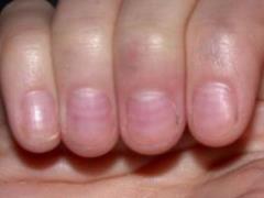 The appearance of the nails can change due to diseases of the heart, kidneys and other organs