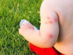 Лікар-інфекціоніст розповіла, чим небезпечні укуси комах