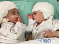 Siamese twins were separated for the first time in Israel