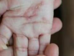 Развенчаны популярные мифы о псориазе