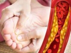 An unexpected sign of excess cholesterol in the blood was named