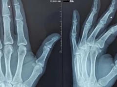 Ученые описали похожее на артрит заболевание, связанное с загрязнением окружающей среды