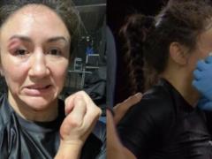 Досадное поражение: эск-чемпионка UFC травмировала себя и проиграла бой