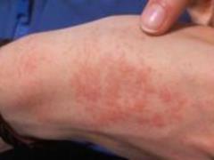 Doctors have pointed out the danger of allergy to cold