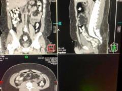 Brazilian man sentenced to 6 years in prison for transporting cocaine in his stomach
