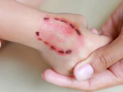 Tetanus protection: what you need to know