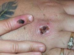 Monkeypox: WHO told who can suffer the most from the disease