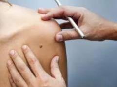 Causes of melanoma identified
