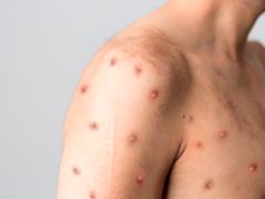 Monkeypox: the largest number of cases of the disease recorded in the United States