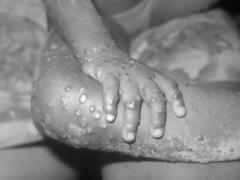 Second monkeypox death recorded in Europe, thousands infected in outbreak country