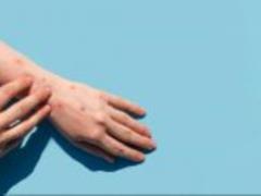 In Europe, for the first time, infections with mavp have died