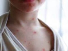 Hepatitis A, cholera, botulism: how not to become a victim of food poisoning