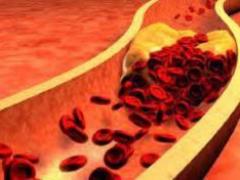 Doctors rozpovіl, how can you prescribe your cholesterol level