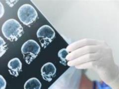 Hiccups may be a warning about the development of stroke and cancer