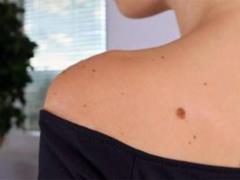 Oncologist: unsafe birthmarks are blamed on the singing houses of the body
