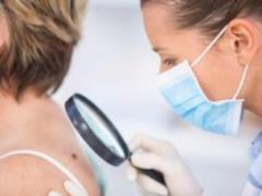 Oncologists have named the main symptom of cancer shkiri and explained how to treat an unsafe birthmark