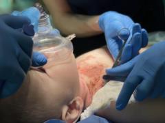 For the first time in Ukraine, a child was transplanted skin from a posthumous donor