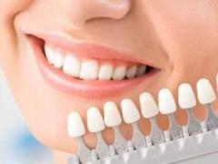 Vidbility teeth without a dentist: a budget option for a beautiful smile