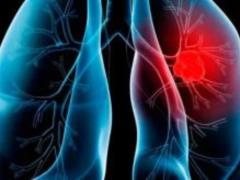 It is possible to diagnose cancer with nails