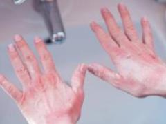 The doctor told about the removal of keratomy and how to get comfortable