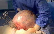 In Kropyvnytskyi, oncologists removed a tumor weighing 10 kg