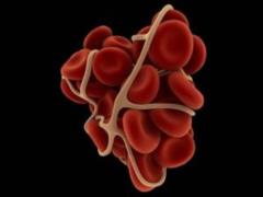 Doctors rozpovidi how to understand that the vein is a blood clot?