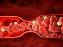 How to stop blood clots: simple ways to reduce risk