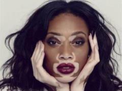 Causes of Vitiligo: Understanding the Factors That Help to Build Up