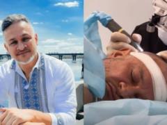 Hector Jimenez-Bravo did a hair transplant and boasted of the result of the operation