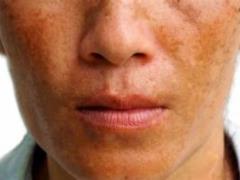 What is melasma