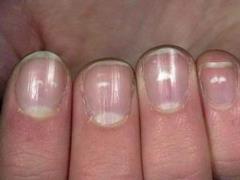 Ключевые признаки дефицита железа и как с ним бороться