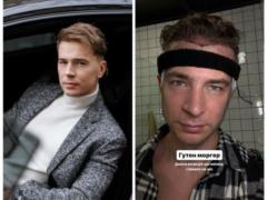 Известный украинский ведущий сделал операцию по пересадке волос и показал весь процесс