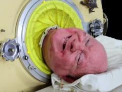 Умер знаменитый «человек в железном легком»