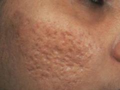 New methods of post-acne treatment: effective techniques and features