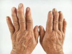 The best foods for people with arthritis: what s unique