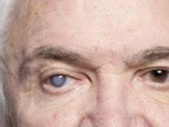 Avoiding Cataracts: Keys to Saving Eyesight