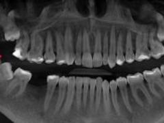 Main symptoms of wisdom teeth eruption
