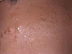Treating white pimples on the nose: causes and recommendations