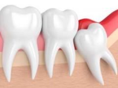 Impacted wisdom teeth: when to remove them and why it is important?