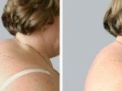 Physical rights to change the hump on the neck