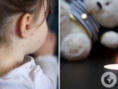 На Буковине от кори умер 10-летний ребенок: имел ли он прививку