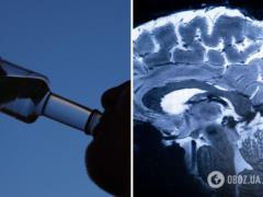 У людей с алкогольной зависимостью обнаружили необратимые изменения в мозге