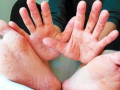 В Киеве фиксируют вспышку кори и гепатита А