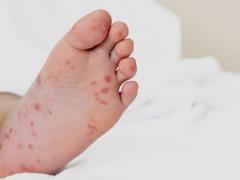 Вспышка вируса Коксаки на Киевщине: заболели 13 детей