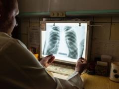 В Украине появляются случаи внелегочного туберкулеза - ЦГЗ