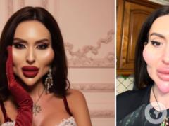 Украинка с самыми большими в мире скулами решила растворить все филлеры на лице и назвала неожиданную причину.